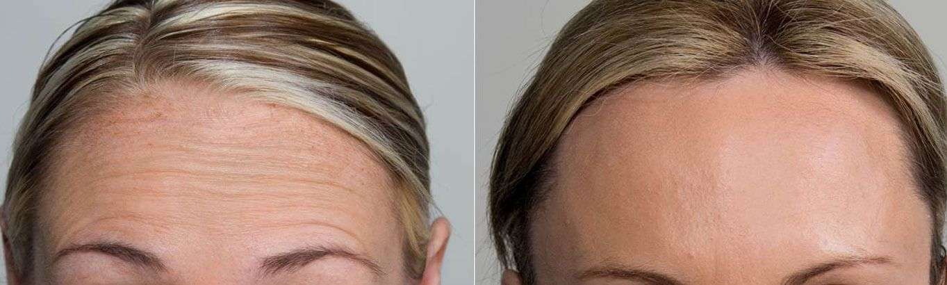 Female Forehead Anti Wrinkle