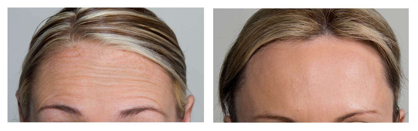 Female Forehead Anti-Wrinkle