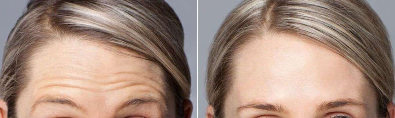 Female Forehead Anti-Wrinkle
