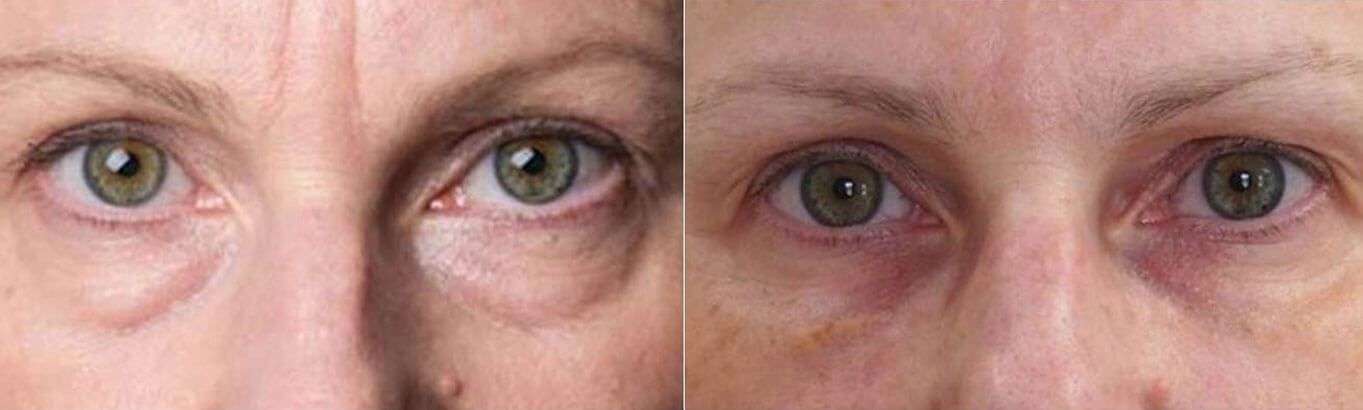 Female Anti Wrinkle Injections