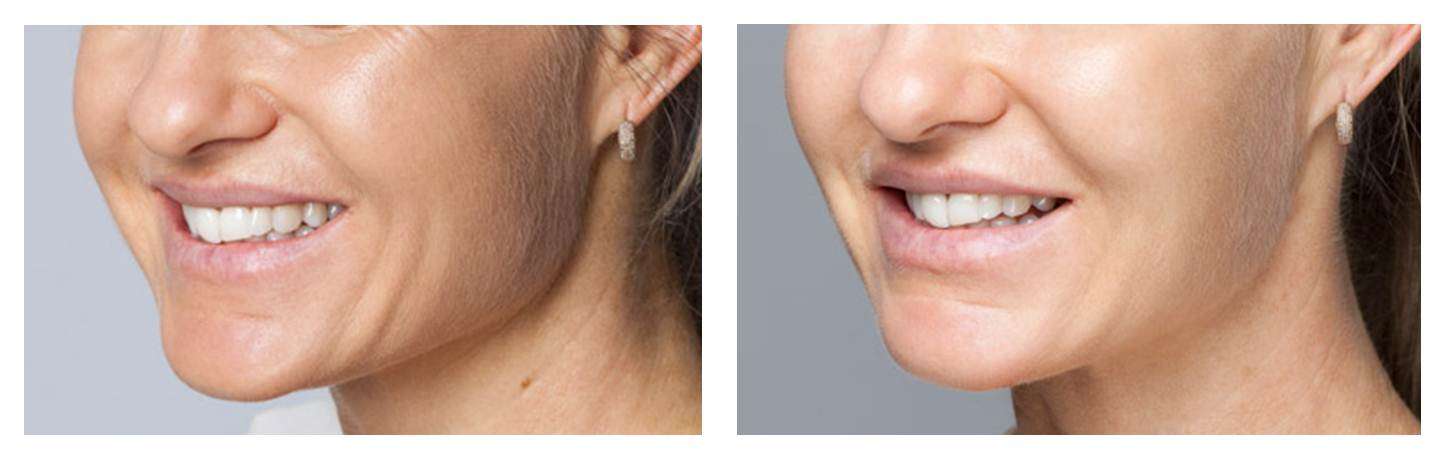 Female Anti-Wrinkle Injections