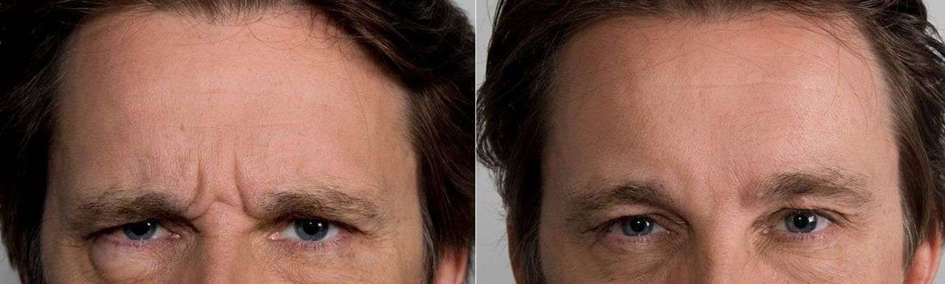 Male Anti-Wrinkle injections